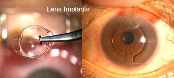 Cataract & Premium Lens Implantation in Indore